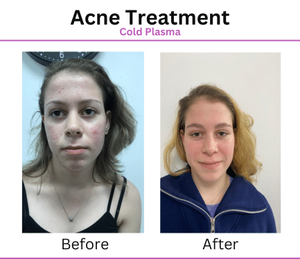 Before After Patient Photos for Acne Treatment with Aurora Plasma Medical Devices