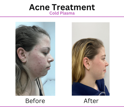 Before After Patient Photos for Acne Treatment with Aurora Plasma Medical Devices