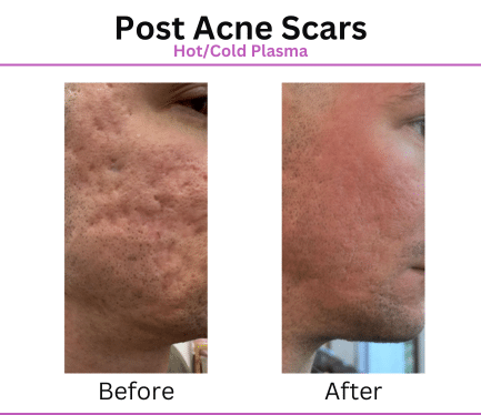 Before After Patient Photos for Post Acne scar Treatment with Aurora Plasma Medical Devices