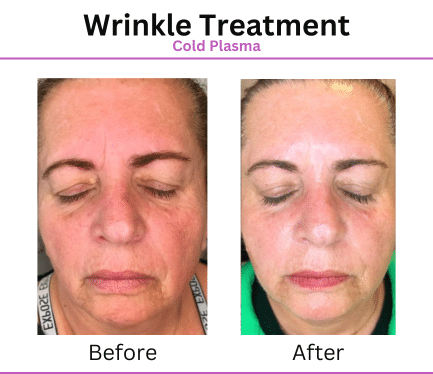 Before After Patient Photos for Wrinkle Treatment with Aurora Plasma Medical Devices