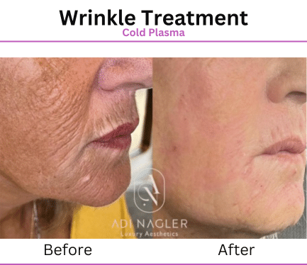 Before After Patient Photos for Wrinkle Treatment with Aurora Plasma Medical Devices